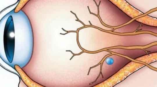 how-is-a-tumor-behind-the-eye-removed
